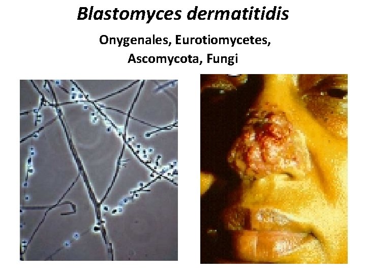 Blastomyces dermatitidis Onygenales, Eurotiomycetes, Ascomycota, Fungi 