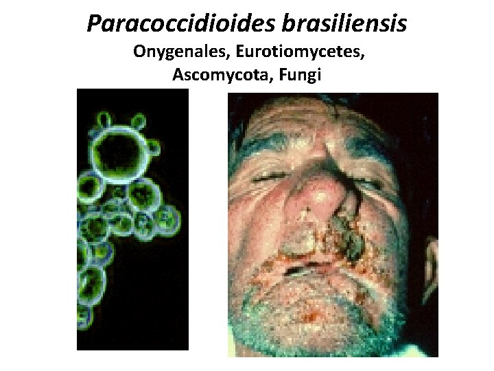 Paracoccidioides brasiliensis Onygenales, Eurotiomycetes, Ascomycota, Fungi 