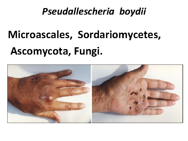 Pseudallescheria boydii Microascales, Sordariomycetes, Ascomycota, Fungi. 