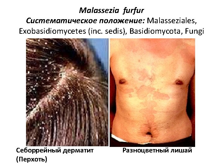 Malassezia furfur Систематическое положение: Malasseziales, Exobasidiomycetes (inc. sedis), Basidiomycota, Fungi Себоррейный дерматит (Перхоть) Разноцветный