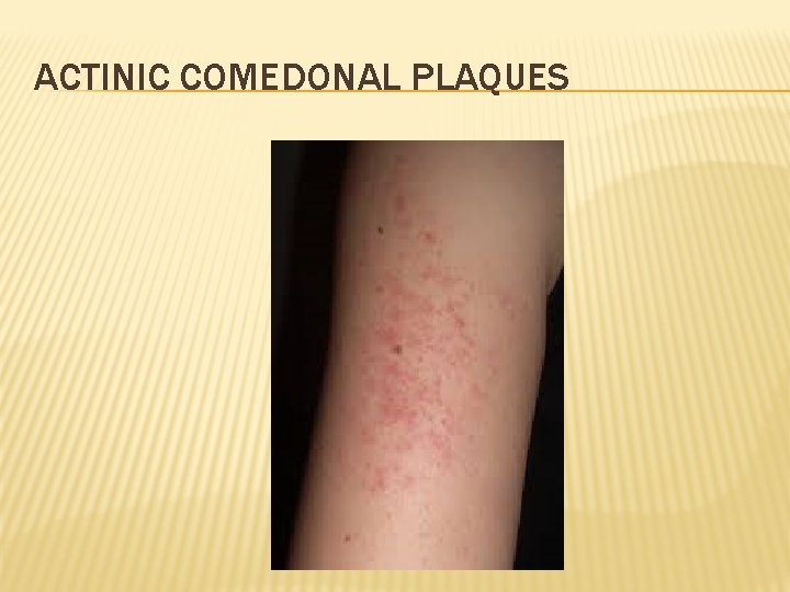 ACTINIC COMEDONAL PLAQUES 