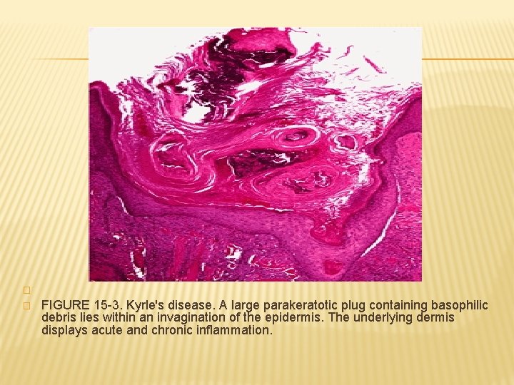 � � FIGURE 15 -3. Kyrle's disease. A large parakeratotic plug containing basophilic debris