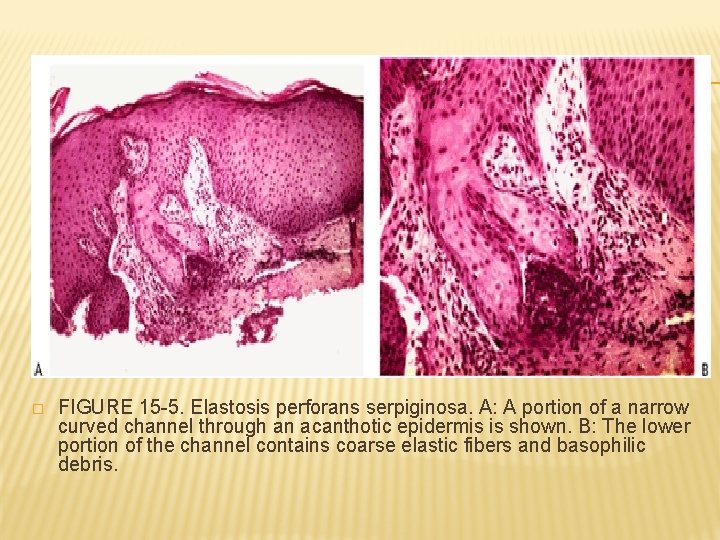 � FIGURE 15 -5. Elastosis perforans serpiginosa. A: A portion of a narrow curved