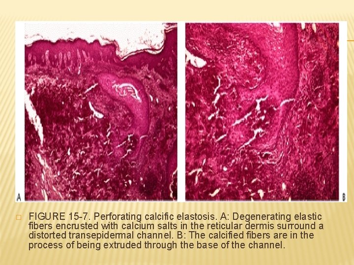 � FIGURE 15 -7. Perforating calcific elastosis. A: Degenerating elastic fibers encrusted with calcium