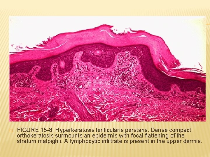 � FIGURE 15 -8. Hyperkeratosis lenticularis perstans. Dense compact orthokeratosis surmounts an epidermis with