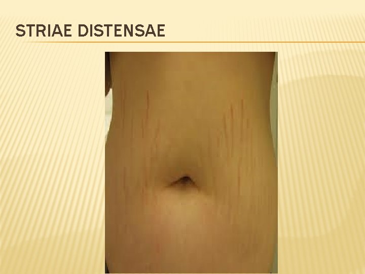 STRIAE DISTENSAE 