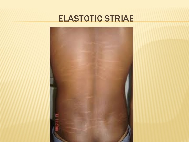 ELASTOTIC STRIAE 