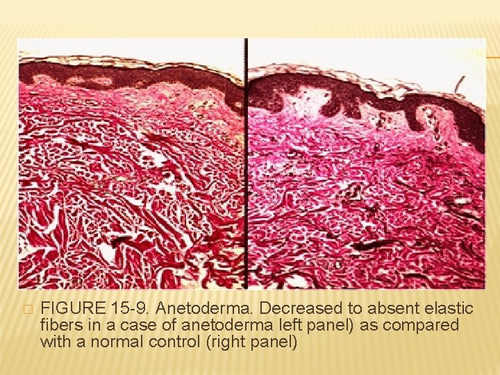 � FIGURE 15 -9. Anetoderma. Decreased to absent elastic fibers in a case of