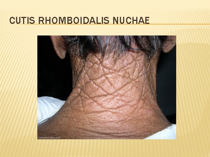 CUTIS RHOMBOIDALIS NUCHAE 