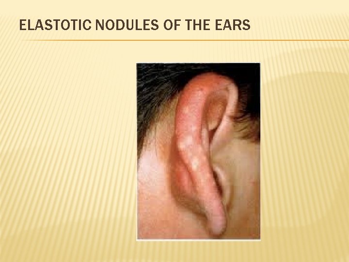 ELASTOTIC NODULES OF THE EARS 
