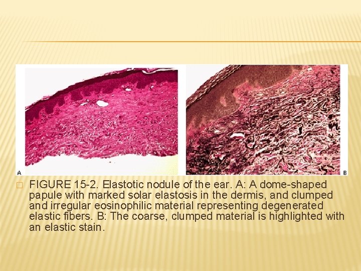 � FIGURE 15 -2. Elastotic nodule of the ear. A: A dome-shaped papule with