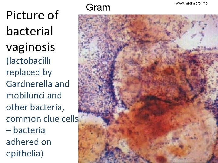 Picture of bacterial vaginosis (lactobacilli replaced by Gardnerella and mobilunci and other bacteria, common