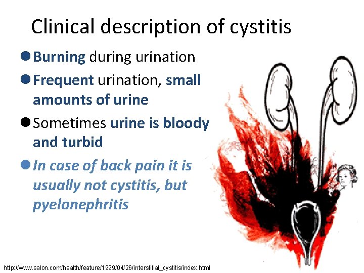Clinical description of cystitis l Burning during urination l Frequent urination, small amounts of