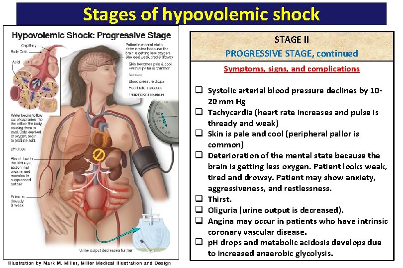 Stages of hypovolemic shock STAGE II PROGRESSIVE STAGE, continued Symptoms, signs, and complications q