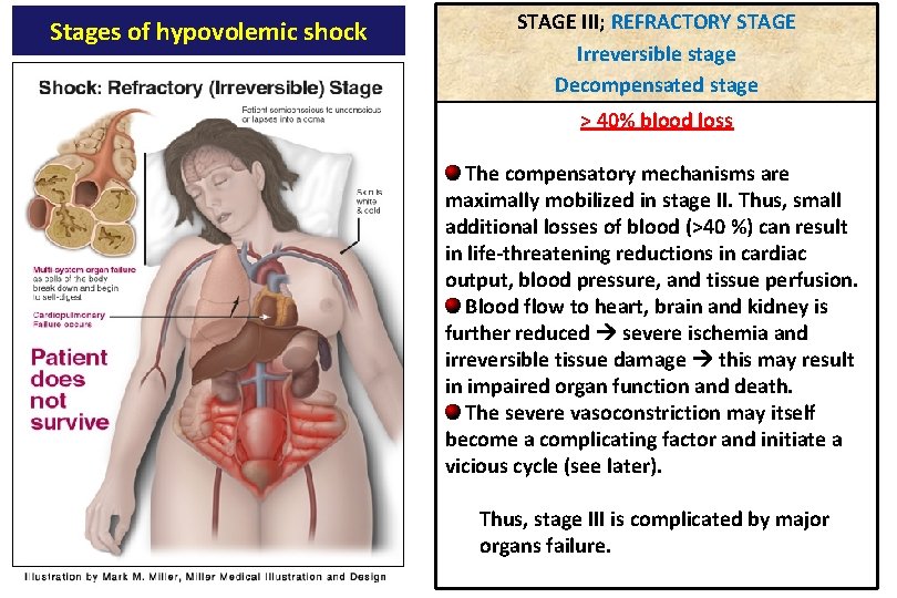 Stages of hypovolemic shock STAGE III; REFRACTORY STAGE Irreversible stage Decompensated stage > 40%