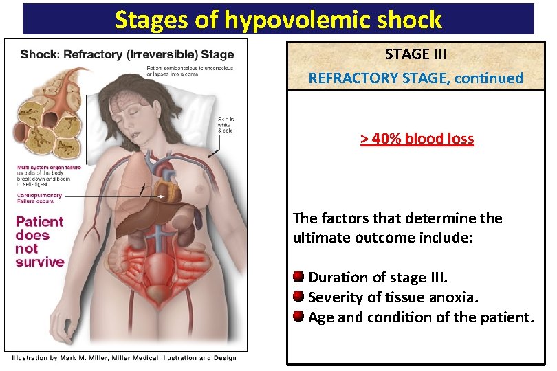Stages of hypovolemic shock STAGE III REFRACTORY STAGE, continued > 40% blood loss The