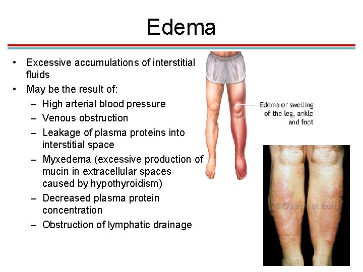 Edema • Excessive accumulations of interstitial fluids • May be the result of: –