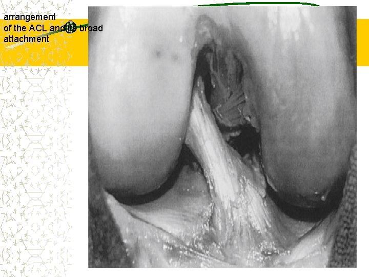 arrangement of the ACL and its broad attachment 