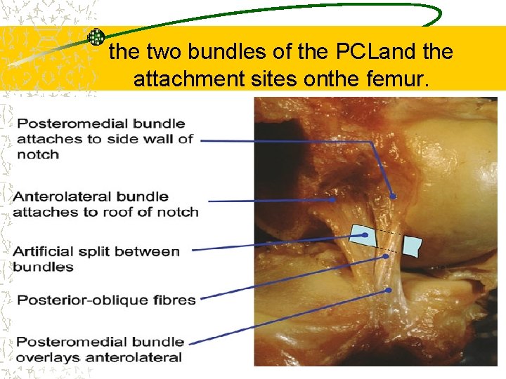 the two bundles of the PCLand the attachment sites onthe femur. 