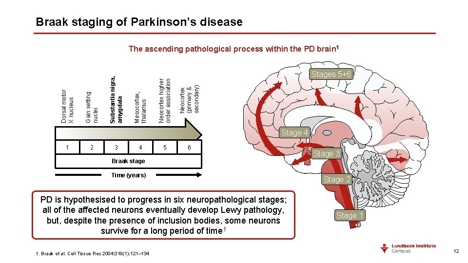 Braak staging of Parkinson’s disease Neocortex (primary & secondary) Neocortex higher order association Stages