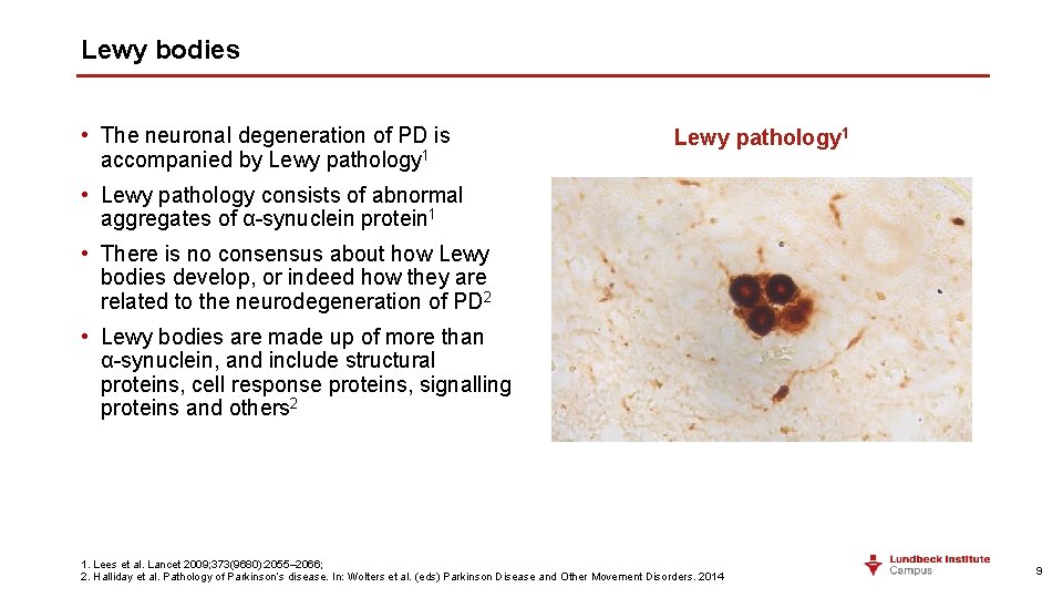 Lewy bodies • The neuronal degeneration of PD is accompanied by Lewy pathology 1