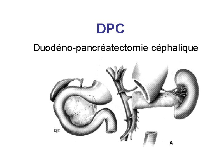 DPC Duodéno-pancréatectomie céphalique 