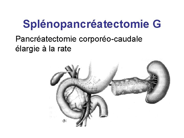 Splénopancréatectomie G Pancréatectomie corporéo-caudale élargie à la rate 
