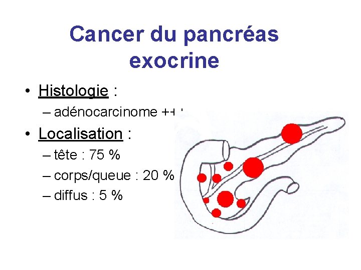 Cancer du pancréas exocrine • Histologie : – adénocarcinome +++ • Localisation : –
