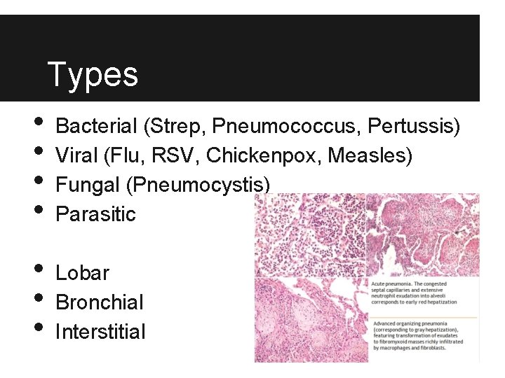 Types • • Bacterial (Strep, Pneumococcus, Pertussis) Viral (Flu, RSV, Chickenpox, Measles) Fungal (Pneumocystis)
