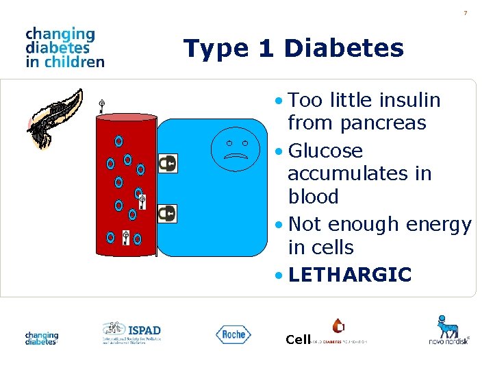 7 Type 1 Diabetes • Too little insulin from pancreas • Glucose accumulates in