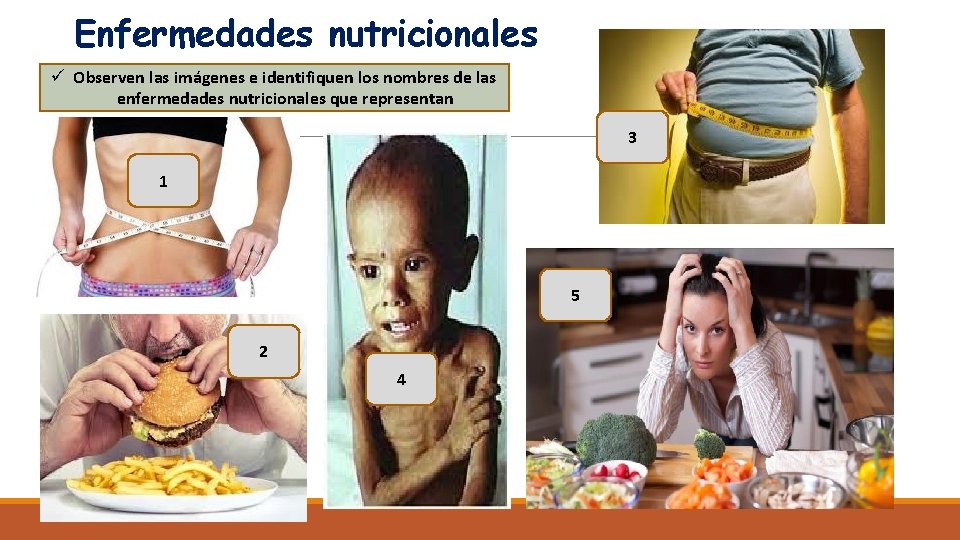 Enfermedades nutricionales ü Observen las imágenes e identifiquen los nombres de las enfermedades nutricionales