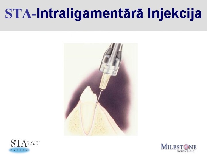 STA-Intraligamentārā Injekcija 