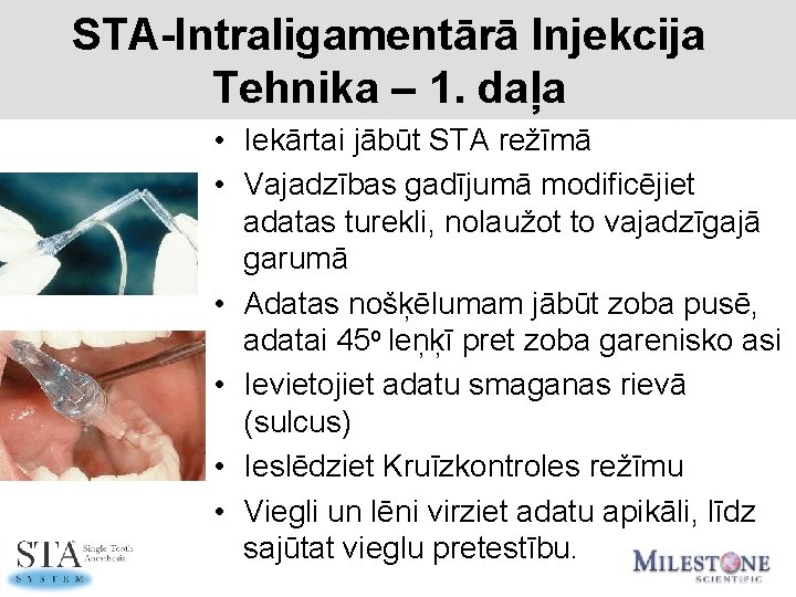 STA-Intraligamentārā Injekcija Tehnika – 1. daļa • Iekārtai jābūt STA režīmā • Vajadzības gadījumā