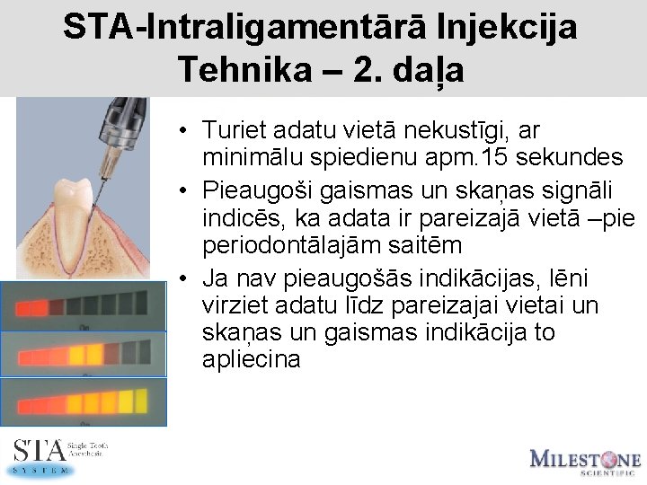 STA-Intraligamentārā Injekcija Tehnika – 2. daļa • Turiet adatu vietā nekustīgi, ar minimālu spiedienu