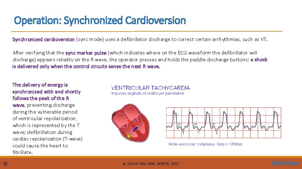 Operation: Synchronized Cardioversion Synchronized cardioversion (sync mode) uses a defibrillator discharge to correct certain