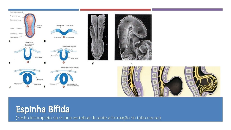 Espinha Bífida (Fecho incompleto da coluna vertebral durante a formação do tubo neural) 