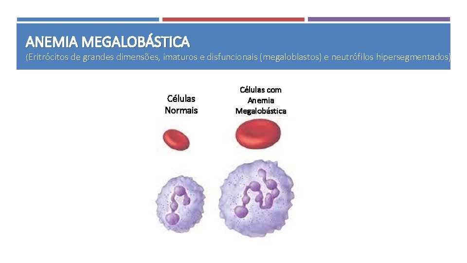 ANEMIA MEGALOBÁSTICA (Eritrócitos de grandes dimensões, imaturos e disfuncionais (megaloblastos) e neutrófilos hipersegmentados) Células