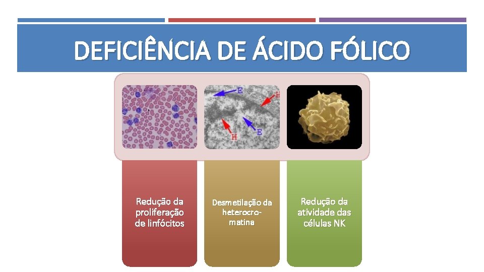 DEFICIÊNCIA DE ÁCIDO FÓLICO Redução da proliferação de linfócitos Desmetilação da heterocromatina Redução da