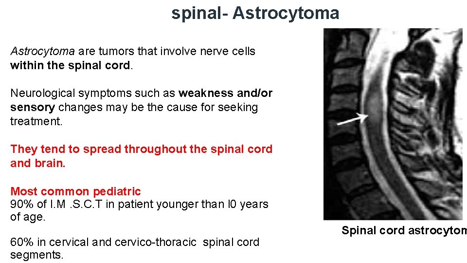 spinal- Astrocytoma are tumors that involve nerve cells within the spinal cord. Neurological symptoms