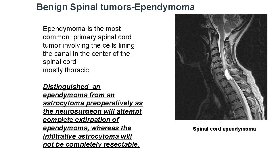 Benign Spinal tumors-Ependymoma is the most common primary spinal cord tumor involving the cells