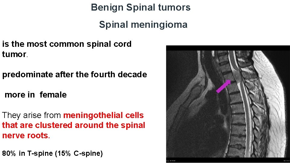 Benign Spinal tumors Spinal meningioma is the most common spinal cord tumor. predominate after