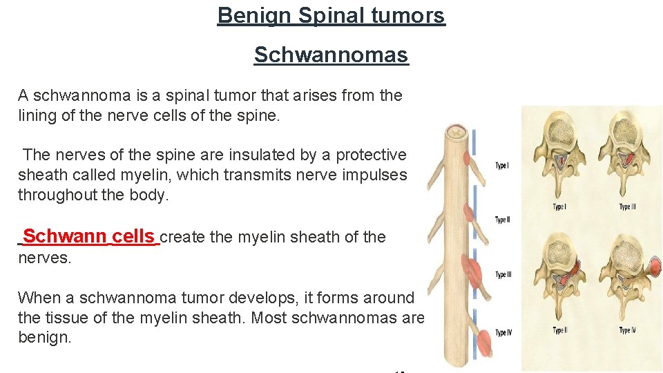Benign Spinal tumors Schwannomas A schwannoma is a spinal tumor that arises from the
