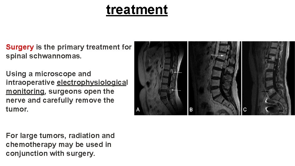 treatment Surgery is the primary treatment for spinal schwannomas. Using a microscope and intraoperative