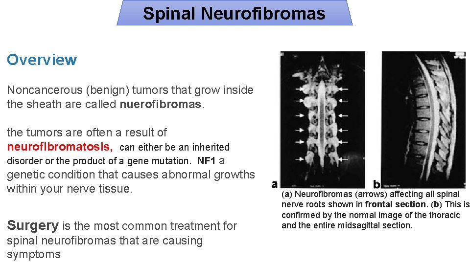Spinal Neurofibromas Overview Noncancerous (benign) tumors that grow inside the sheath are called nuerofibromas.