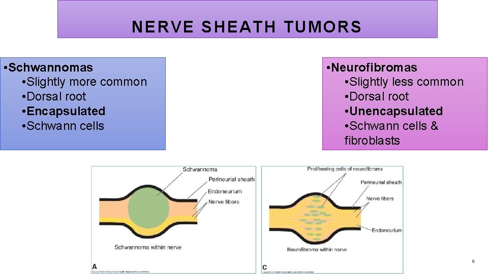 NERVE SHEATH TUMORS • Schwannomas • Slightly more common • Dorsal root • Encapsulated