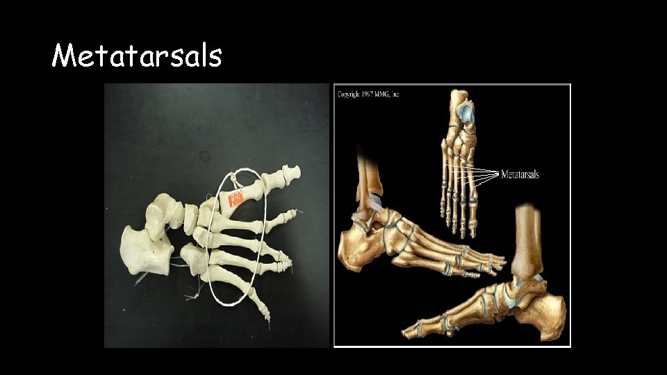 Metatarsals 