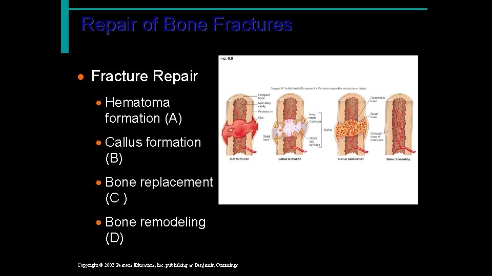 Repair of Bone Fractures · Fracture Repair · Hematoma formation (A) · Callus formation