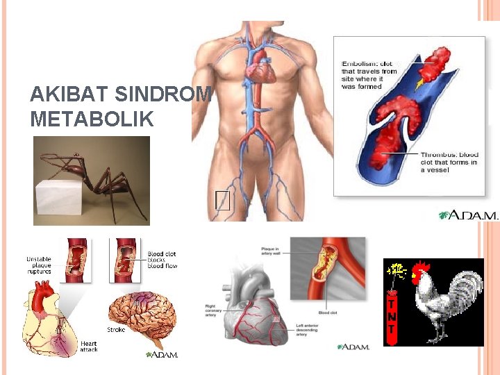 AKIBAT SINDROM METABOLIK 