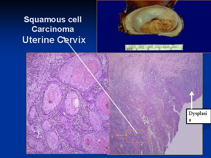 Squamous cell Carcinoma Uterine Cervix Dysplasi a 