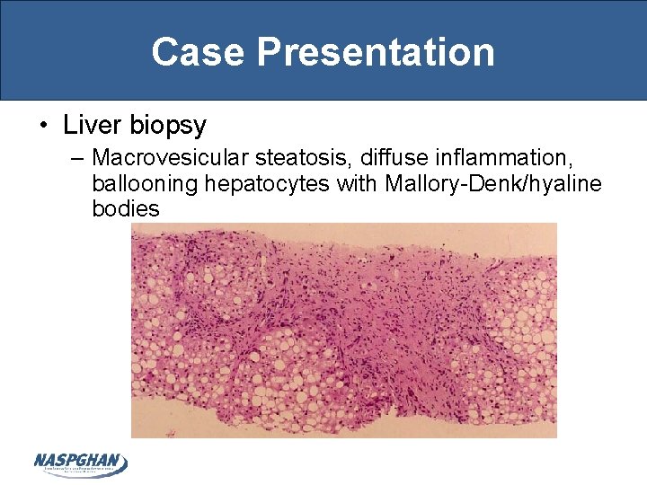 Case Presentation • Liver biopsy – Macrovesicular steatosis, diffuse inflammation, ballooning hepatocytes with Mallory-Denk/hyaline